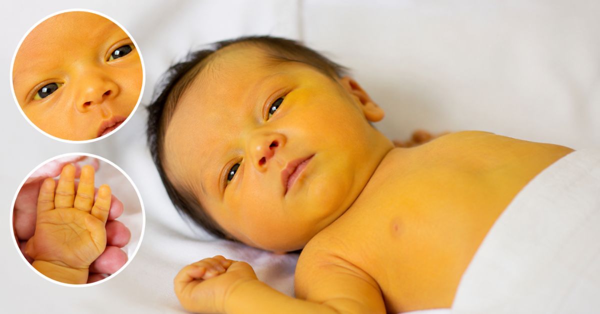 Newborn Jaundice